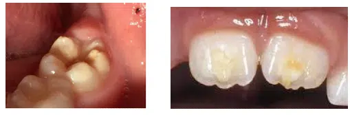 På det første billede ses en seksårstand med en gullig brun plettet emalje. På det andet billede vises to fortænder med tydeligt gullig brune pletter