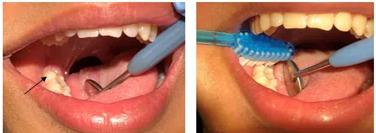 På det første billede ses en visdomstand dækket delvist af tandkød. På det andet billede ses visdomstanden, hvor man børster på tværs af tanden i frembrudsfasen.