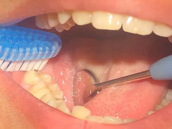 Bagerste tand blive børstet med en tandbørste, på tværs af tanden i frembrudsfasen.