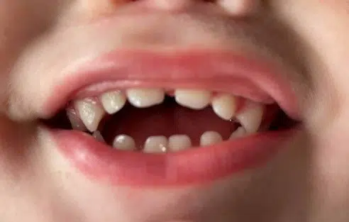 Barnemund med suttebid