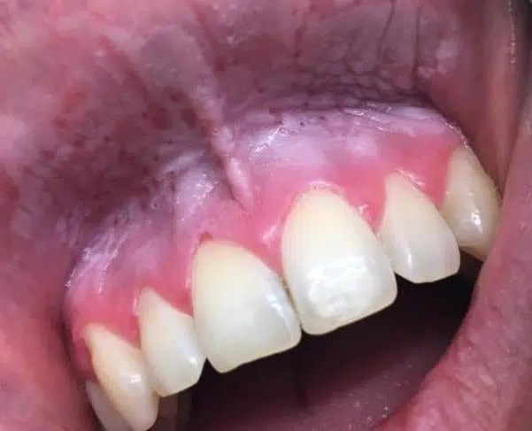 Mund med slimhindeforandringer i form af hård hud med hvidlige, rynkede plamager, der hvor snusen lægges