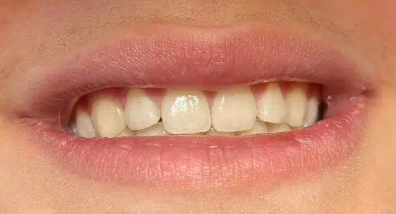 Sunde tænder uden syreskader