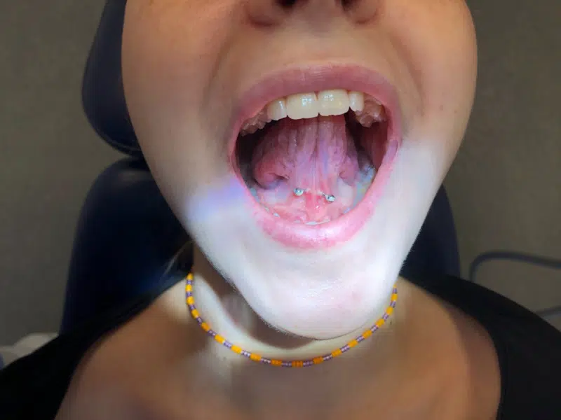 Mund hvor piercing er placeret under tungen. Bakterieansamling i form af plak/tandsten ses på piercingen.