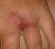 Samme hånd tre dage senere. Der er gået hul på vablen og huden er rød og iriterret