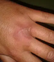 Vabel fra saften af bjørneklog dagen efter hånden blev ramt